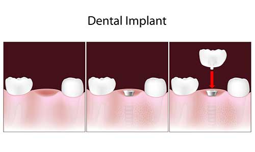 Implant Dentist in Savannah