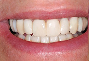 Before and After Dental Implants in Savannah