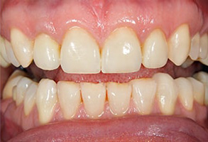 Before and After Teeth Whitening in Savannah