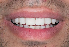 Before and After Dentures near Georgetown