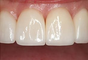 Before and After Dental Fillings in Savannah