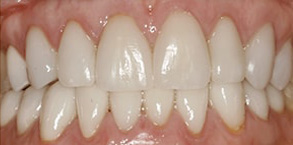 Before and After Invisalign near Georgetown