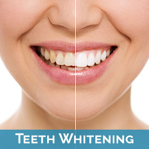 St. Augustine Teeth Whitening