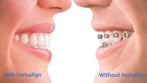 Invisalign in St. Augustine