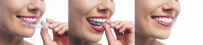 St. Augustine Invisalign